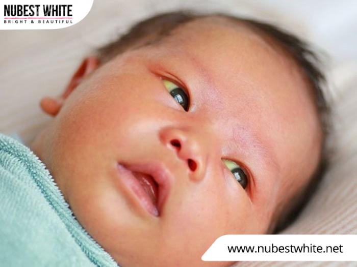 Mạch máu chưa hoàn thiện khiến da em bé đỏ khi vừa sinh ra