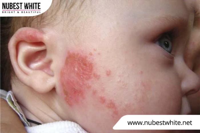 Da em bé bị đỏ có thể do chàm sữa